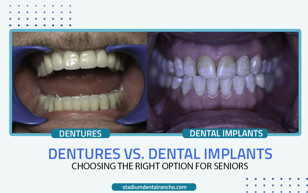 Removable partial dentures