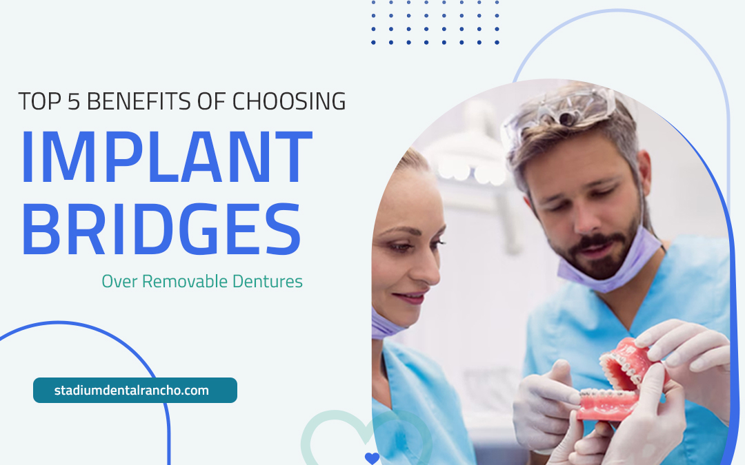 Dental bridges in Rancho Cucamonga