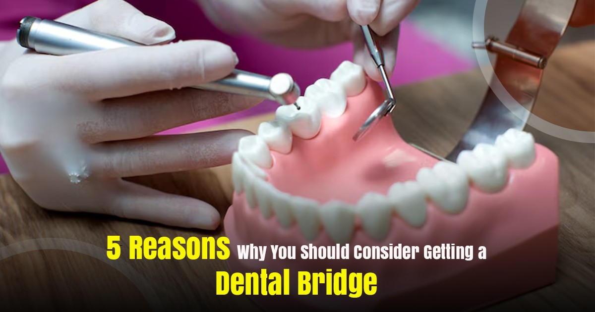 Dental Bridges in Rancho Cucamonga