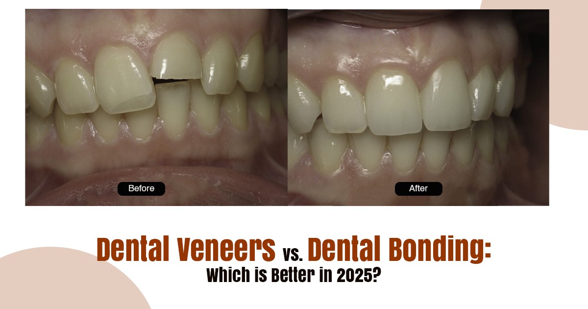 Dental Veneer in Rancho Cucamonga