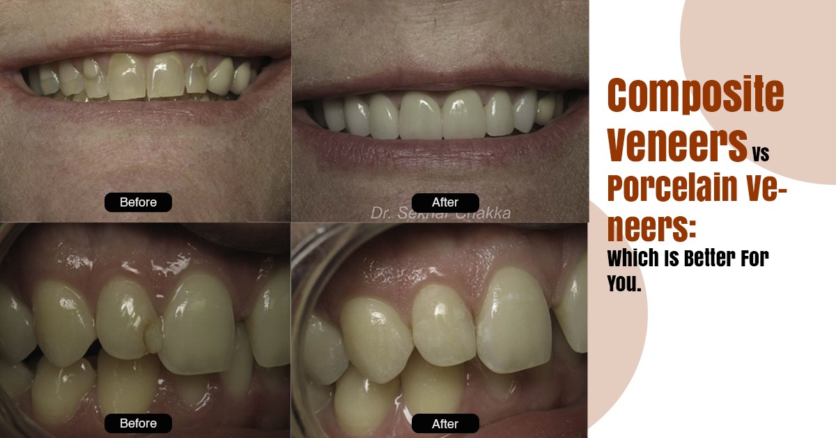 veneers in Rancho Cucamonga