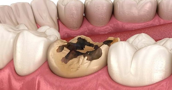 Chipped Tooth