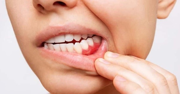 Sensitive Teeth